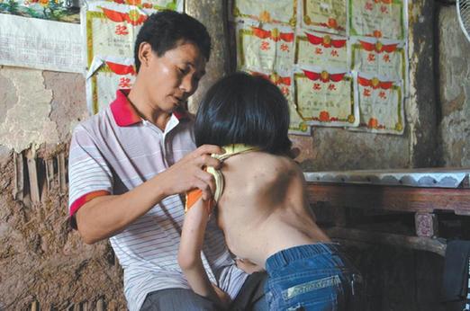 有嚴重脊椎畸形及胸腔隆突病的李文霞。