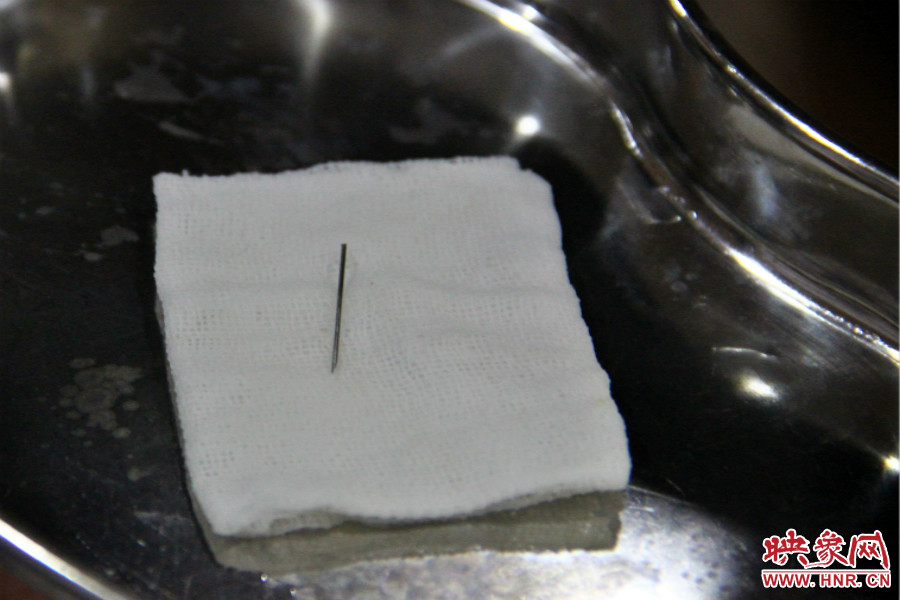 上午11點30分許，小龍腦中鋼針已經(jīng)成功取出。