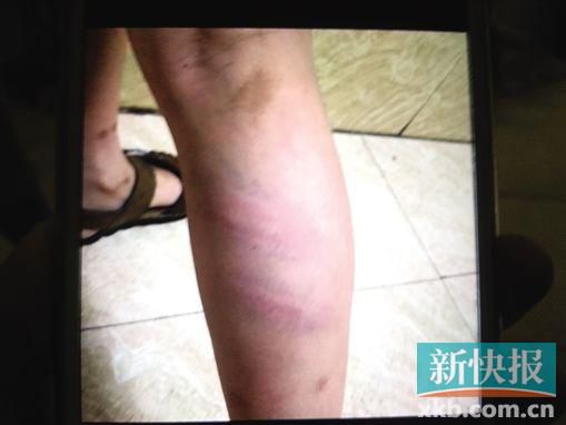 小宇腿部有明顯瘀痕。 翻拍自家屬手機