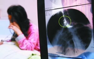 假牙上的鋼絲刺破食管，而薄薄的食道壁緊貼主動脈血管，極易造成血管破裂