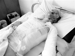 周小姐的頭、頸、軀干、四肢均被燒傷，其中面部燒傷最為嚴(yán)重。