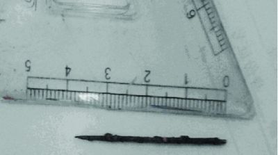 取出的繡花針已發(fā)黑生銹。