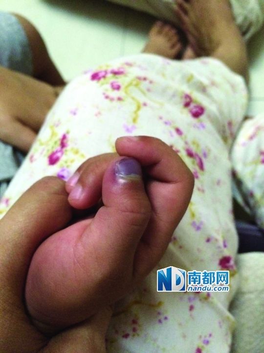 小逸手指被夾傷。