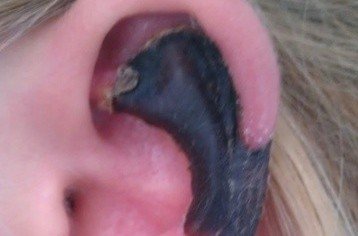 荷蘭女子旅游途中被蜘蛛咬，耳軟骨溶解變黑。