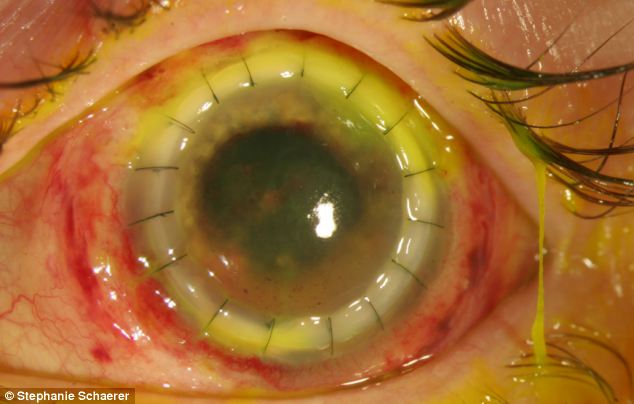 恐怖慎入！隱形眼鏡致英女子摘除眼球