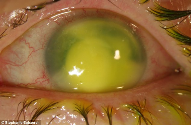 恐怖慎入！隱形眼鏡致英女子摘除眼球