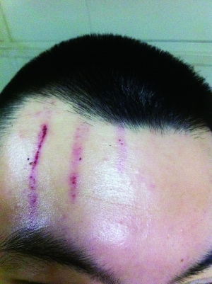 　2013年，被打者受傷照