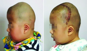 術(shù)前（左），術(shù)后（右）