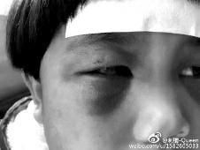 6月2日，網(wǎng)曝渭南市臨渭區(qū)一不滿5歲的女童遭奶奶毆打，眼圈青腫，引起網(wǎng)友關(guān)注，但孩子父母和爺爺均稱是摔倒導致。相關(guān)部門介入調(diào)查發(fā)現(xiàn)確為奶奶毆打所致，鑒于其身體原因已進行批評教育。