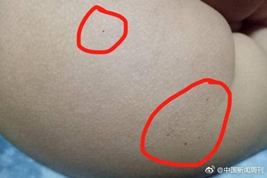 據(jù)多名紅黃藍(lán)(新天地分園)家長反映，孩子腿部、屁股、腋下出現(xiàn)針眼。