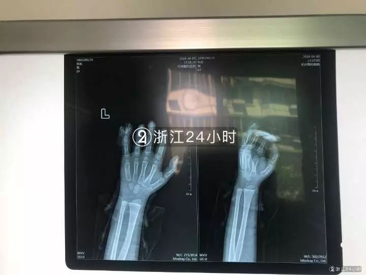 嚇哭！6歲男孩被夾斷手指 罪魁禍?zhǔn)拙故切７? oldsrc=