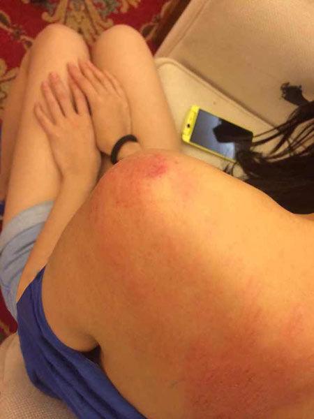 “跑男”真的很拼！baby朋友圈曬后背紅腫照