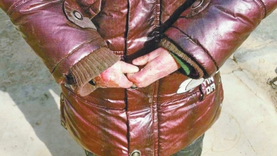 長期受損的手指，已經(jīng)長在了一起。