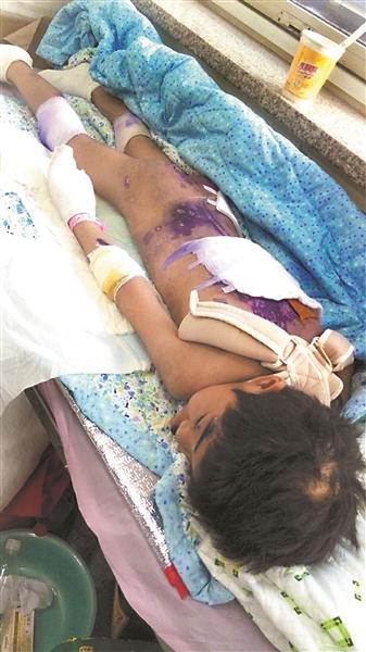 女童遭“國學老師”虐打致多處骨折 被罰吃廁紙 女童遭“國學老師”虐打致多處骨折 被罰吃廁紙