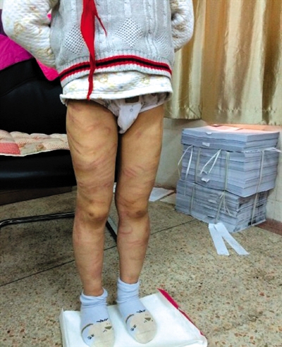 4月3日晚，微博網友“@朝廷半日閑”發(fā)圖文微博展示男童被虐待的慘狀。 微博截圖