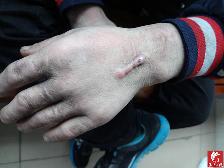 被發(fā)現(xiàn)男子手上的傷疤。