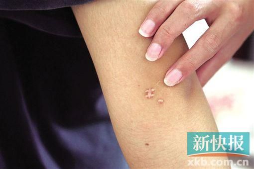 取出針后李星兒手臂留下了傷口。新快報(bào)記者 張國鋒/攝