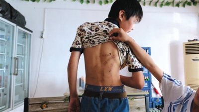 　昨日，奶西村，被打的小剛后背上條條瘀痕依然明顯。