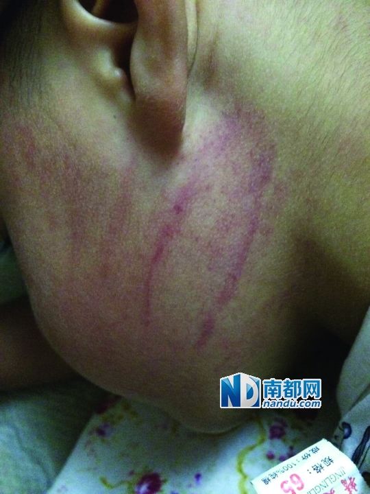 小逸臉上淤痕清晰可見。