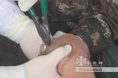 正在拆除戒指。