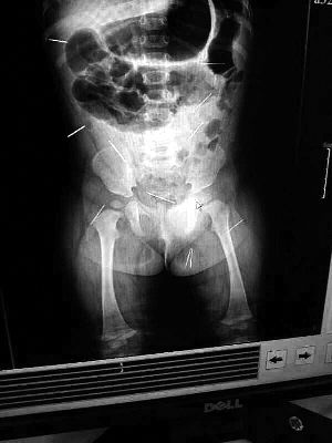 目前體內的12根鋼針多分布在孩子的臀部，一根在腹部，其余3根在胸腔附近，其中一根很接近心臟