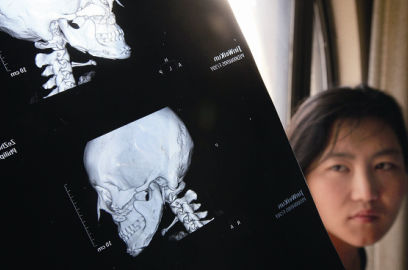 國內(nèi)醫(yī)院CT顯示，如今靳魏坤的鼻子假體是歪的，連下巴也是歪的