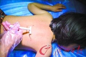 9歲女童得怪病 因服用廉價(jià)激素藥物致全身長(zhǎng)毛