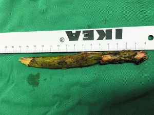 插入男子腦內(nèi)的樹枝。