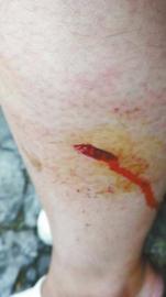 郭女士腿上被猴子咬的傷口。(受訪者供圖)