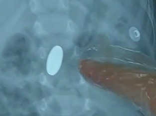 男童被蘋(píng)果卡氣管 就醫(yī)時(shí)竟發(fā)現(xiàn)胃里“藏”硬幣